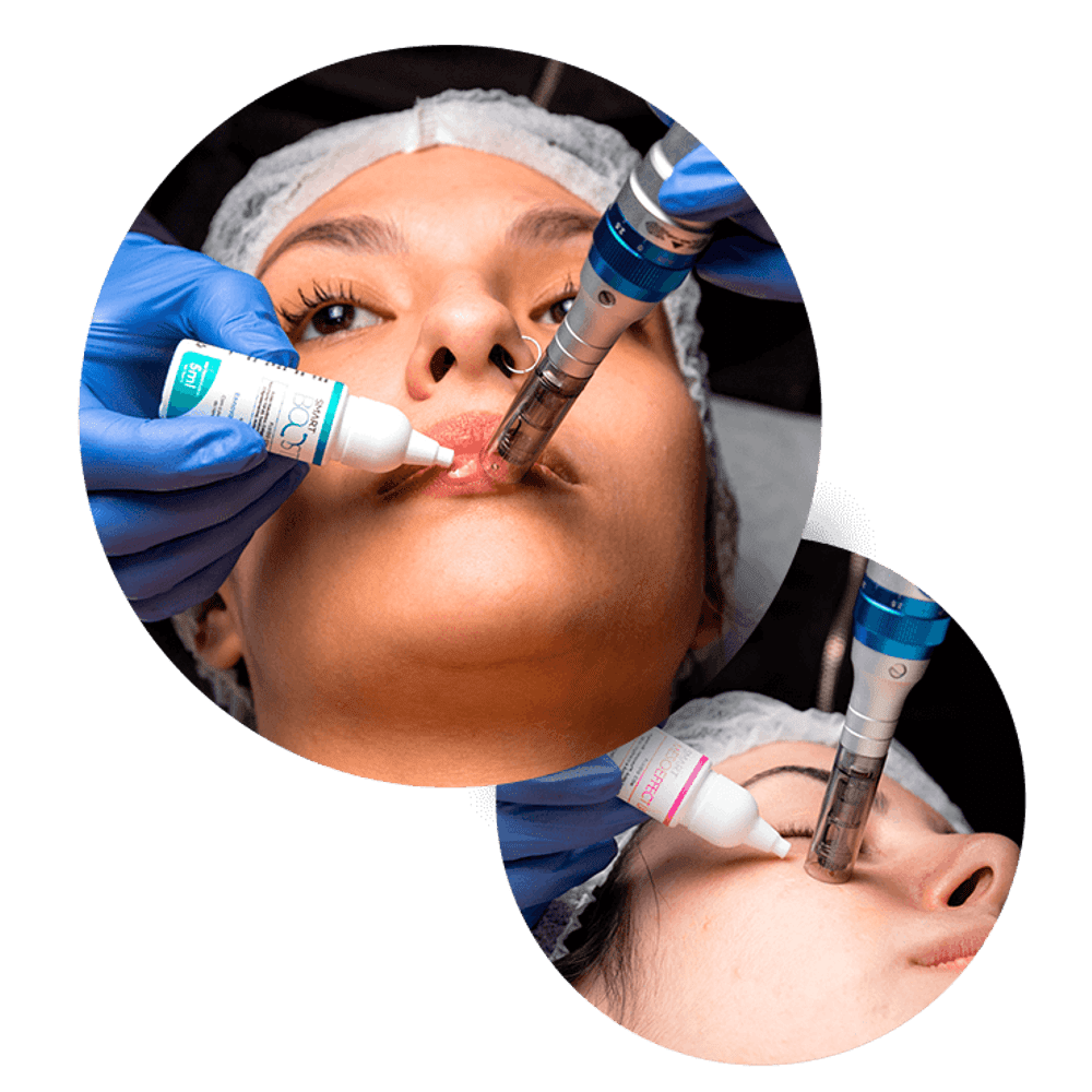 tratamentos de pele com microagulhamento